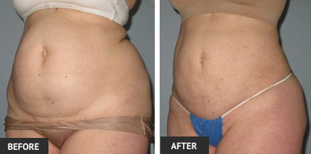 Liposuction Surgery