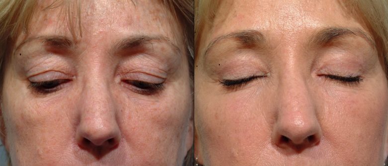 Eyelid Surgery