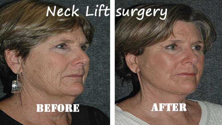 Neck Lift Surgery