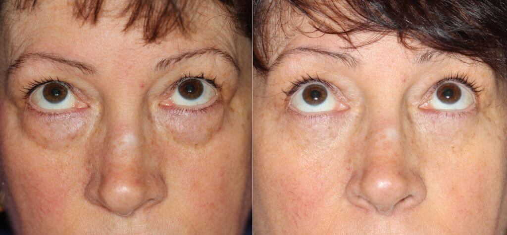 eyelid surgery