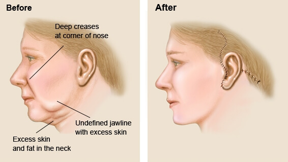 face lift surgery
