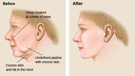 face lift surgery