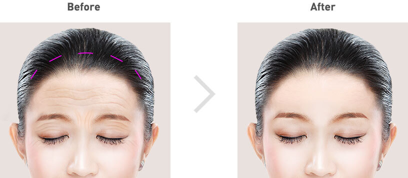 forehead lift surgery