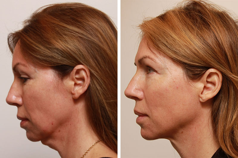 neck lift surgery