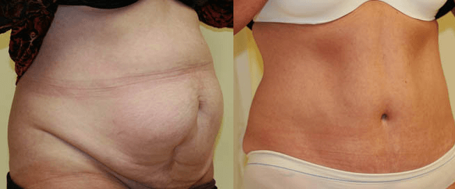 tummy tuck surgery